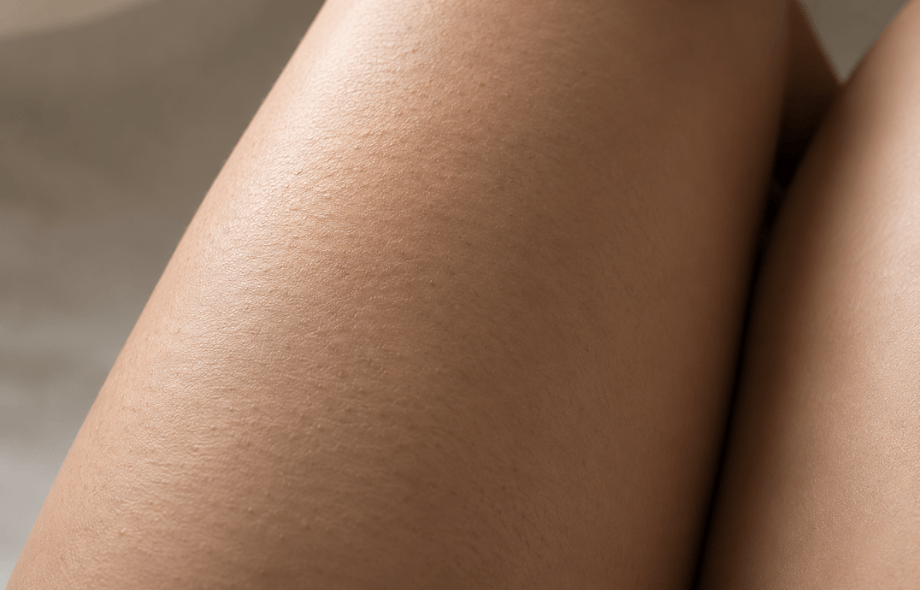 Cellulite da stress: come riconoscerla