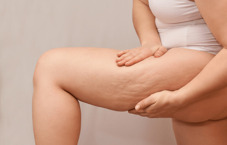 Il meccanismo: cortisolo, infiammazione e cellulite